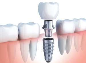 implantes dentrales