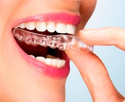 Invisalign