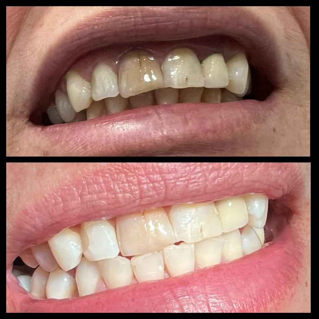 Estética Dental: Expertos en Blanqueamiento Dental.