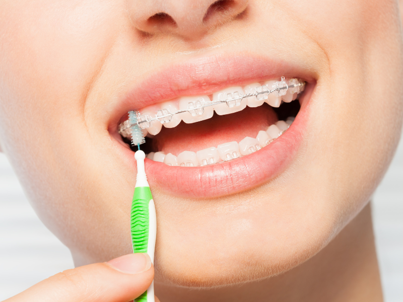 Cómo cuidar tus dientes durante un tratamiento de ortodoncia